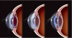 氢治疗对视网膜缺血再灌注神经损伤的保护作用