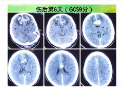 miR-21在氢气保护创伤性脑损伤中作用机制