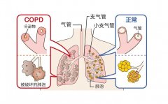 吸入氢气对慢性低氧性肺动脉高压的影响