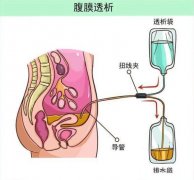 分子氢对腹膜透析患者的临床研究