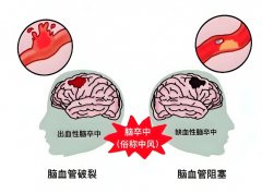 临床证实日常饮用氢水有助中风康复