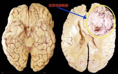 高浓度分子氢：一种潜在的胶质瘤克星