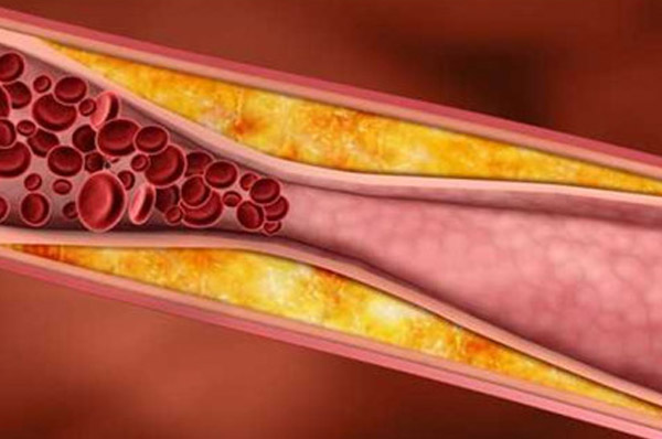 动脉粥样硬化是怎么回事 氢气：血管健康的“清道夫”