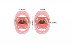 富氢水缓解5-FU诱导的口腔粘膜溃疡