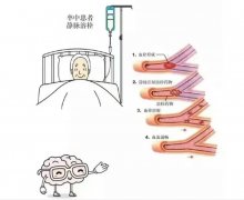 氢动力微马达在急性缺血性脑卒中的精准改善研究