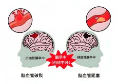 氢气：为中风患者带来新希望的神奇气体