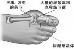 氢水对高尿酸血症有调节作用