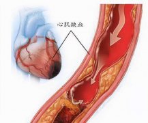 氢气、富氢水在临床疾病中的应用综述